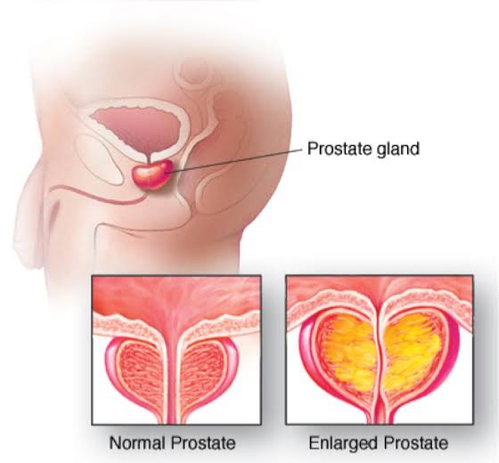 Men's Health Focus: Protecting Your Prostate through Prevention and Early Detection!